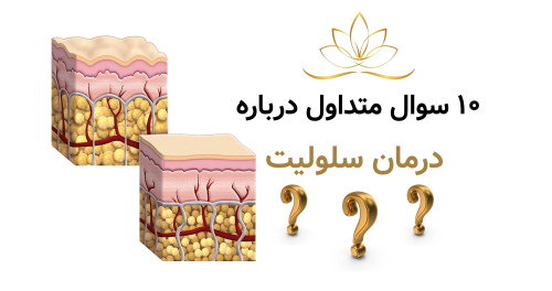 ۱۰ سوال متداول درباره درمان سلولیت