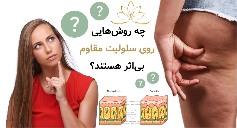 چه روش‌هایی معمولاً روی سلولیت مقاوم بی‌اثر هستند؟